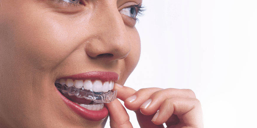 Invisalign